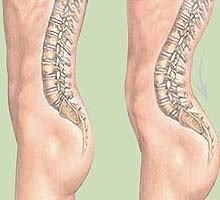 Lumbar Lordosis, or, as medical professionals call it,  Ghetto Booty.